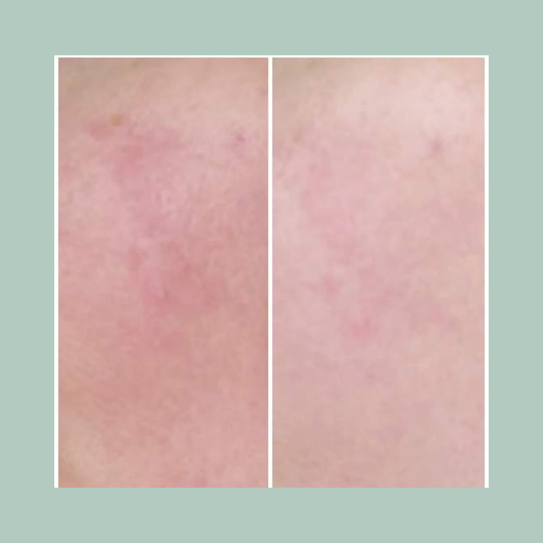 Rosacea Treatment Bundle